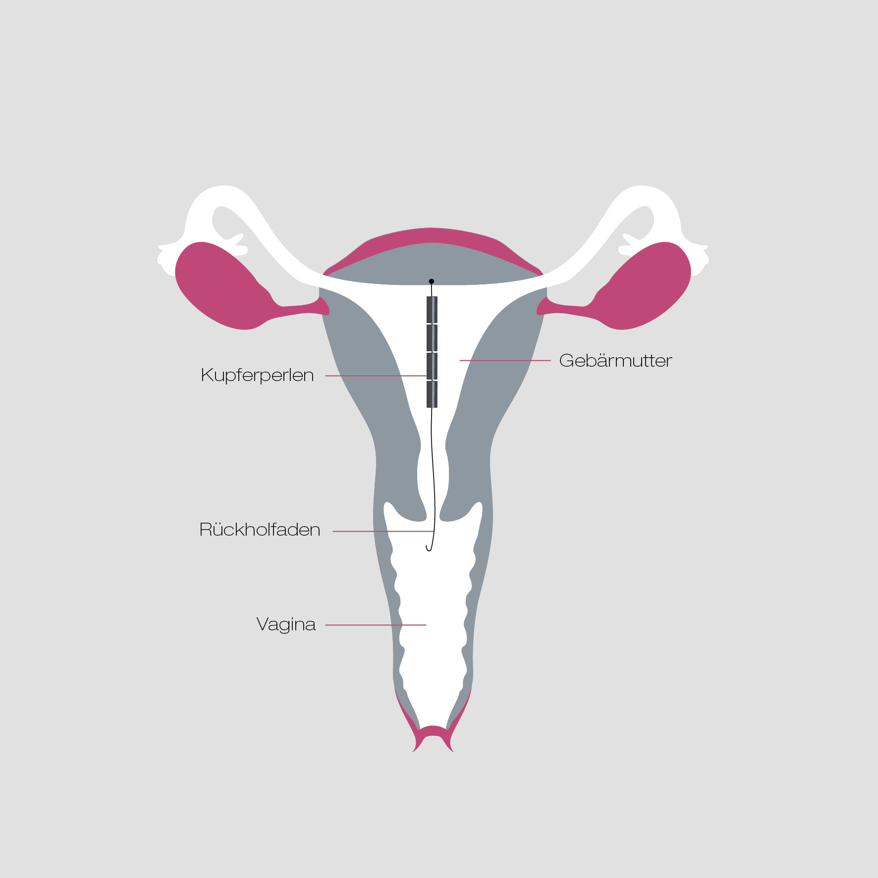 Ein Diagramm zur Veranschaulichung hormonfreier Verhütungsmöglichkeiten für die weibliche Gebärmutter.