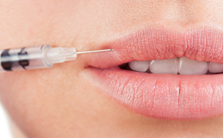 Nahaufnahme eines Teils eines Gesichts, das nur den Mund einer Person zeigt, die eine Lippenaufspritzung mit einer Injektionsspritze erhält. Die Spritze ist nahe der Lippe positioniert, bereit, eine Füllsubstanz zu injizieren, was auf eine kosmetische Verbesserung der Lippen hindeutet.