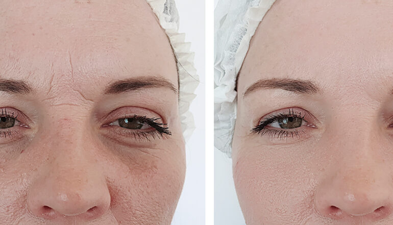 Vorher-nachher-Bilder einer Frau, die eine kosmetische Laserbehandlung im Gesicht erhalten hat. Auf dem Vorher-Bild sind deutlich feine Linien, Falten und Hautunebenheiten zu erkennen. Im Nachher-Bild wirkt die Haut sichtlich geglättet und verjüngt. Die Frau trägt eine Schutzhaube und hat ein entspanntes Gesicht mit leichtem Make-up.
