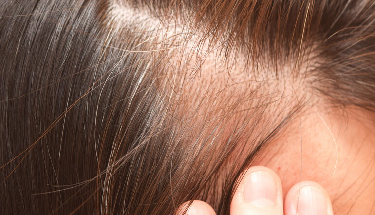 Eine Frau nutzt moderne Medizin, um Haarausfall zu bekämpfen.