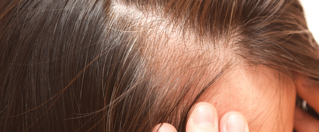 Eine Frau nutzt moderne Medizin, um Haarausfall zu bekämpfen.